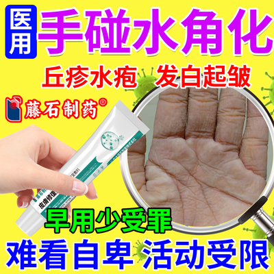 水源性肢端角化症手碰水就皱外用软膏水泡丘疹手癣膏角化开裂SK