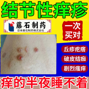 结节性痒疹专用皮肤湿疹特红硬疙瘩身上痒拔毒止痒效药房同售膏CA