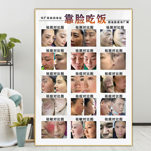 祛斑祛痘海报宣传图斑痘敏墙壁挂画美容院广告装饰画痘印痤疮墙贴