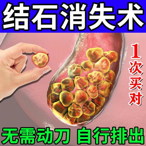 胆治疗结石溶石化石排石专用药化石草鸡内金胆囊结石息肉贴中成药