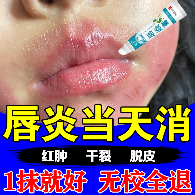 儿童唇炎唇膏嘴唇防干裂脱皮治口角炎嘴巴角干燥起皮开裂专用药膏