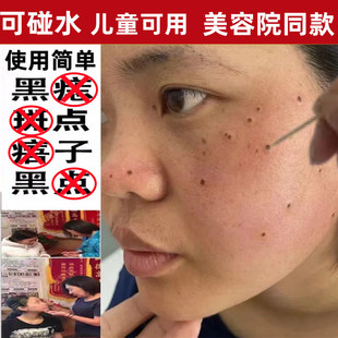 点斑水痣膏正品脸部药取痣去黑痣雀点痦子美容院专用神器去除志仪