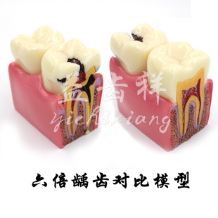 牙科教学 成人病理医患沟通牙膜 口腔科六倍龋齿双侧对比模型包邮