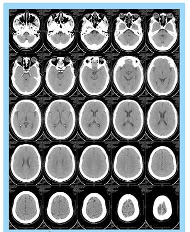高温热敏胶片热敏相机用 医用胶片干式14X17/8X10/10X12/11X14