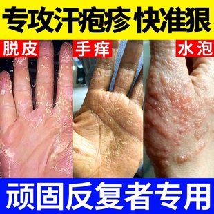 汗皰疹汗泡皰疹藥膏汗孢疹手上起小水泡手癢汗狀濕疹止癢皮膚脫皮