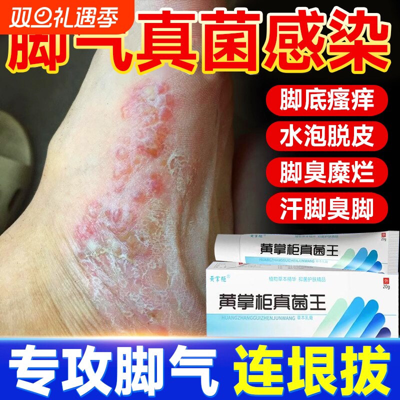 真菌王官网正品脚臭止痒脱皮脚痒水泡烂大腿内侧抑菌杀菌膏