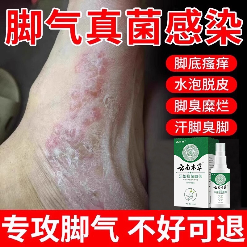 脚气喷雾止脱皮痒杀菌去真菌感染专用根糜烂脚丫脚趾缝除臭出汗根