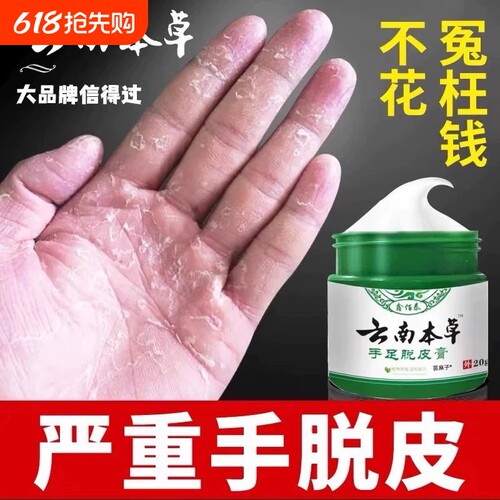 手足脱皮膏手指上真菌蜕皮干燥起皮童手掌蜕皮手心手脚掉皮褪专用