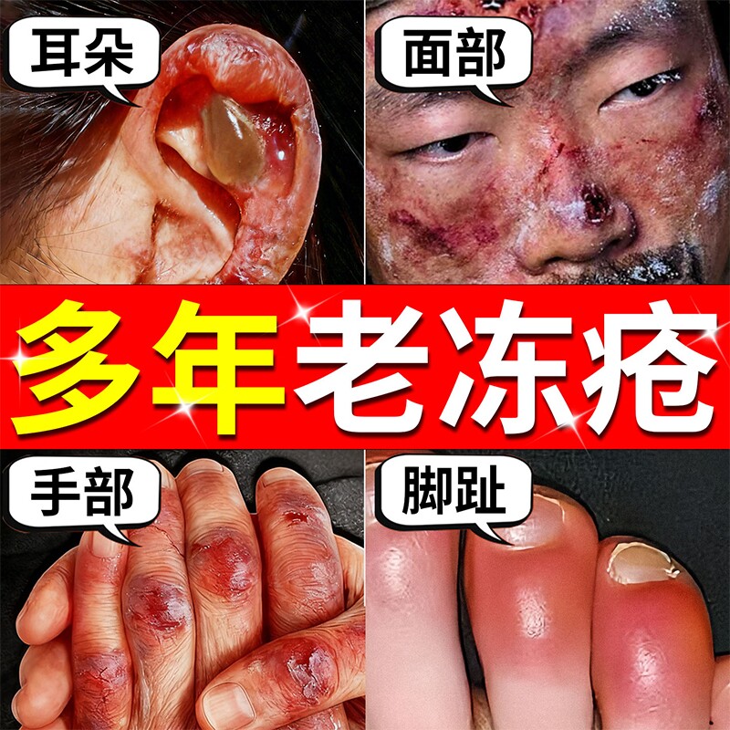 冻疮膏止痒冻伤膏正品防冻排行榜第一名官方旗舰店儿童耳朵手冻伤