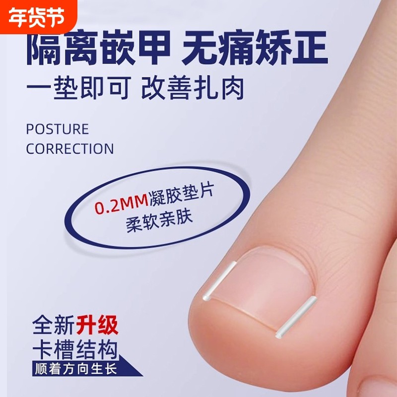 甲沟矫正器炎嵌甲神器纠正指甲扎肉大脚趾甲往肉里长隔离填充垫片