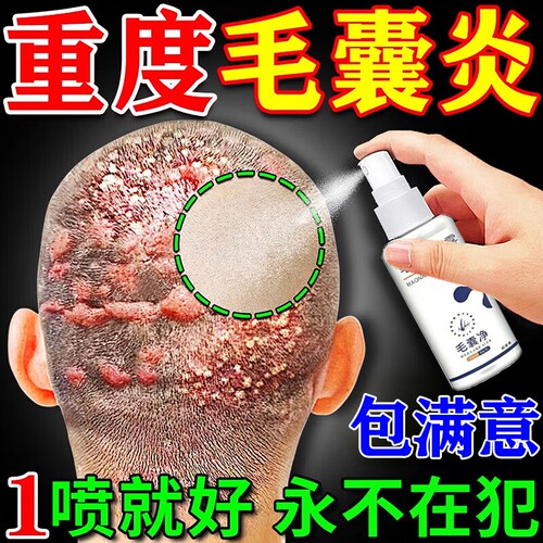 头皮毛囊炎喷雾剂头皮痒有疙瘩马拉色真菌头部硬专用皮肤消毒周围