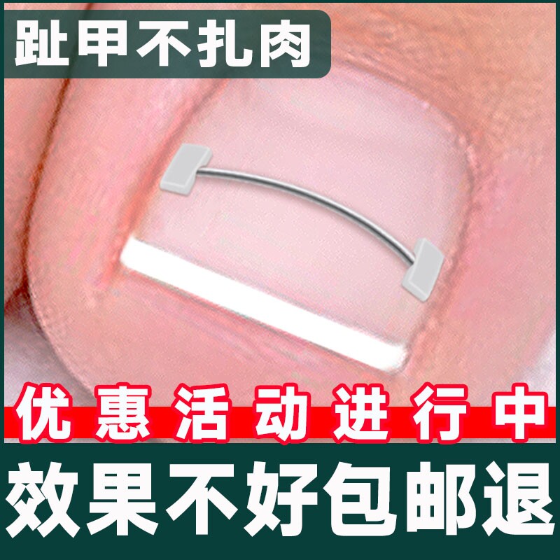 正甲丝镍钛合金记忆回弹钢丝正甲扣嵌甲矫正器正甲贴拉拉炎正甲垫