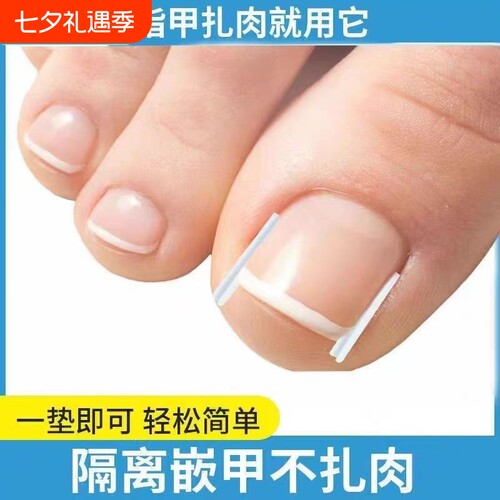 嵌甲矫正垫片|超6000次加购