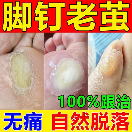 脚钉祛除膏去除厚脚垫老茧死皮根去脚底板脚掌趾硬皮软化剂药足部