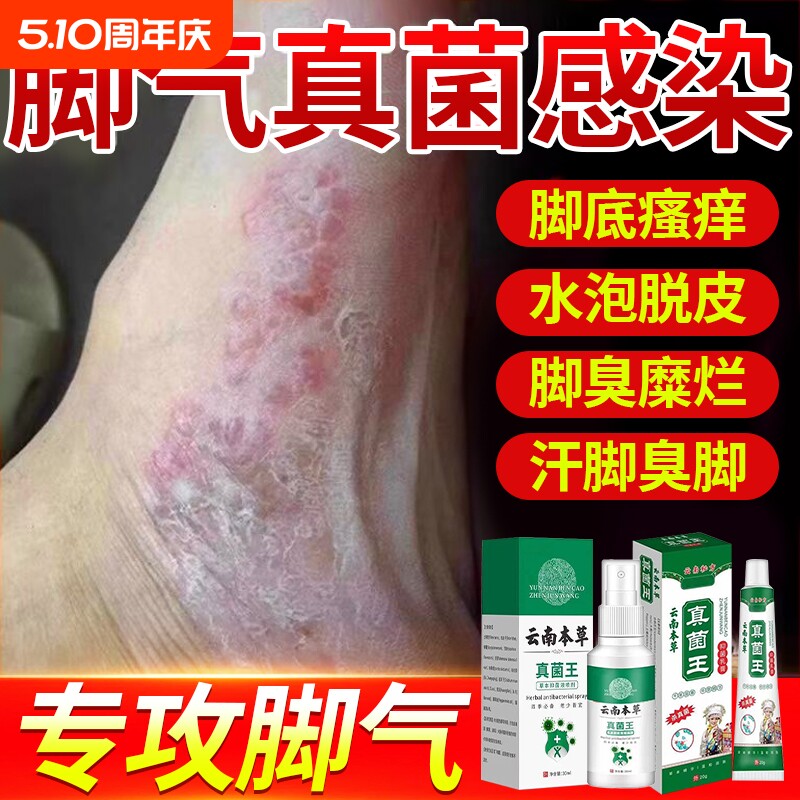 云南本草脚气喷雾止痒脱皮杀菌去真菌感染专用根糜烂脚丫脚趾缝臭