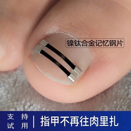 镍钛记忆回弹钢片嵌甲矫正器