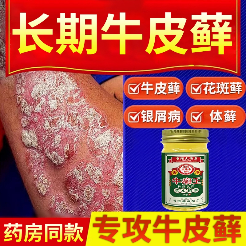 【牛皮藓癣克星】去屑止痒第一名