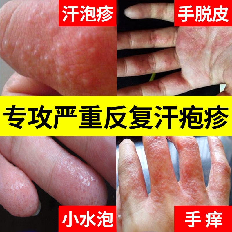 汗疱疹汗泡疱疹药膏汗孢疹去手上起小水泡手痒汗状湿疹止痒根皮肤 医疗器械 保健理疗 原图主图