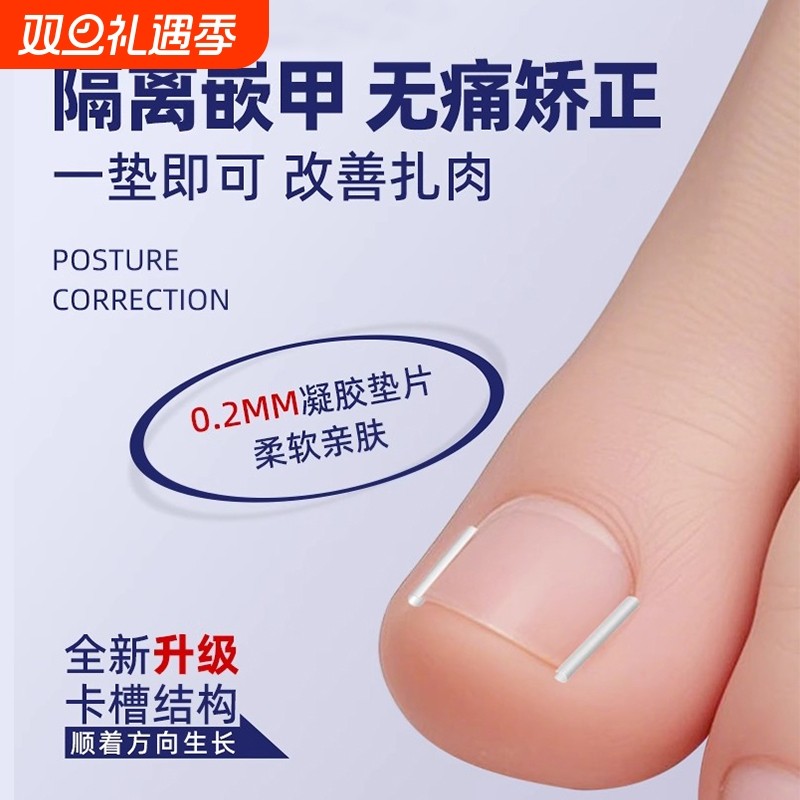 甲沟矫正器炎嵌甲神器纠正指甲扎肉大脚趾甲往肉里长隔离填充垫片