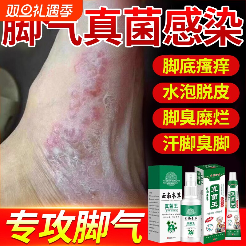 云南本草脚气喷雾止痒脱皮杀菌去真菌感染专用根糜烂脚丫脚趾缝臭