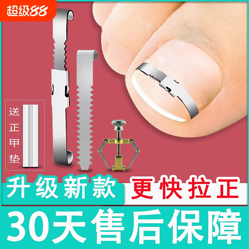 甲沟矫正器正甲扣嵌甲矫正器脚趾甲卷指甲纠正神器拉拉炎正甲贴片