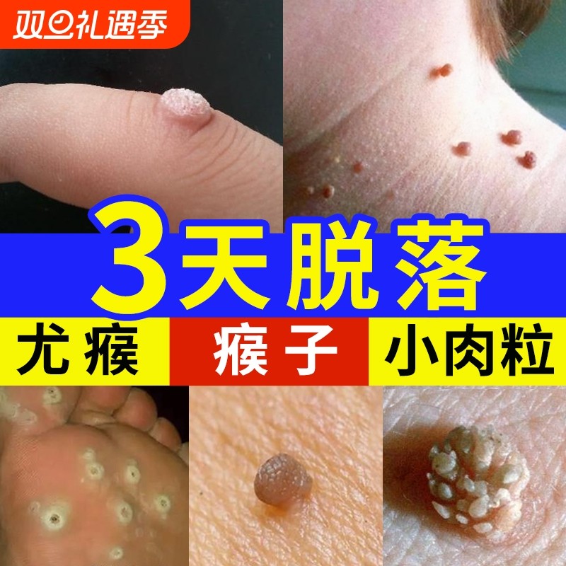 去除尤疣瘊猴子祛除扁平神器脖子上长小肉粒疙瘩一抹无忧灵药膏