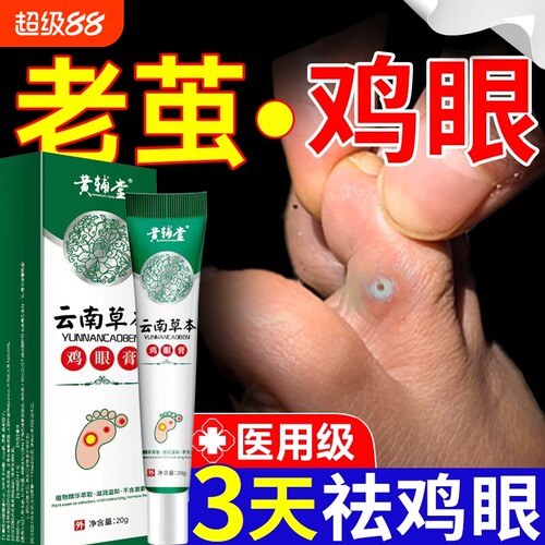 云南草本鸡眼膏官方正品旗舰店鸡茧子鸡眼脚部脚底老茧20g医用级