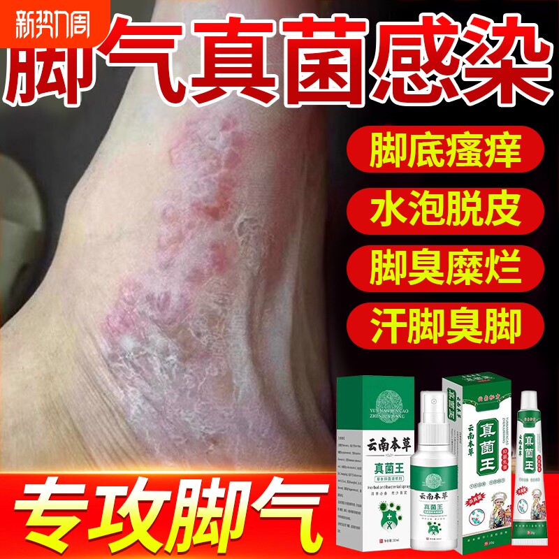 云南本草脚气喷雾止痒脱皮杀菌去真菌感染专用根糜烂脚丫脚趾缝臭