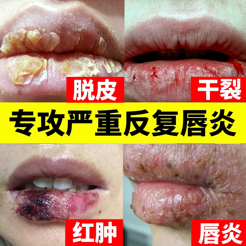唇炎膏药贴专用补水|千人加购