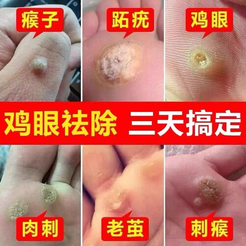 【云南本草】鸡眼膏，买就送贴