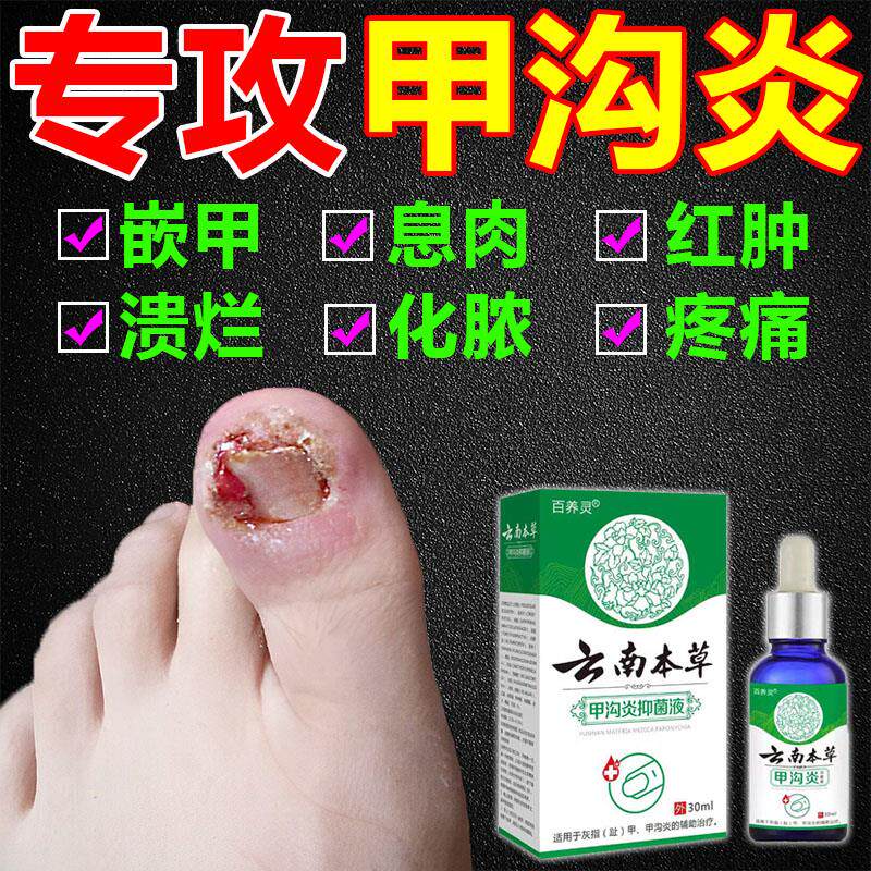 甲勾炎专用膏药治疗外用特效脚大拇指药水夹钾岬沟炎胛钩炎甲沟炎