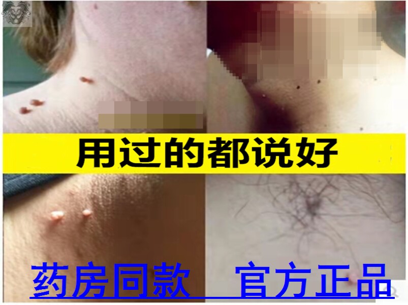 身上脖子颈部长小肉粒疙瘩瘊子刺猴鱼鳞痣丝状克尤皮赘去除神器