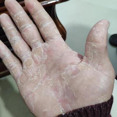 手脱皮严重脱皮专用真菌蜕皮干燥起皮药膏护手霜脱皮干裂用什么药