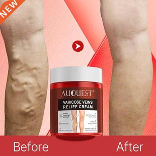 AUQUEST Varicose Veins Relief Cream Vasculitis Phlebitis Spi