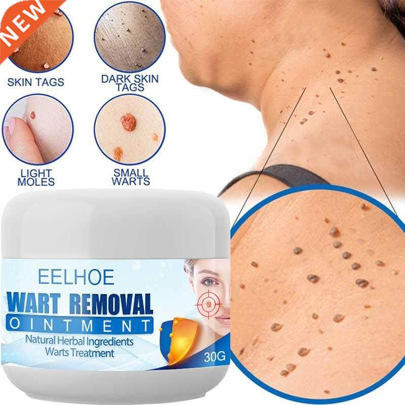 painless wart remover cream treatment of the skin of the nec