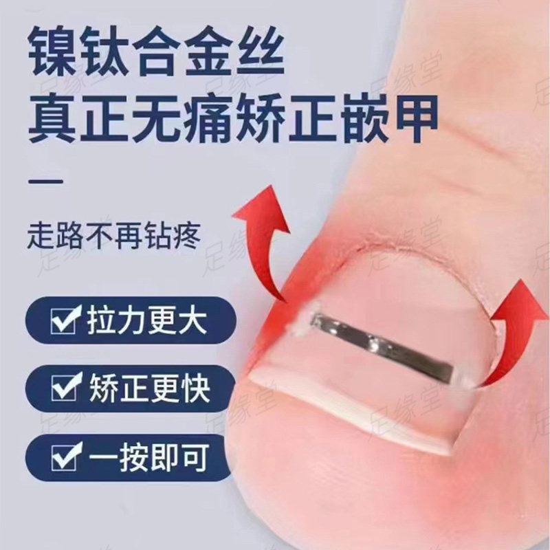 镍钛正甲贴记忆丝钢丝硅胶贴矫正卷甲修脚趾甲痛炎甲沟疼刀嵌甲片