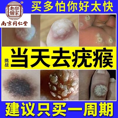 疣清宁克疣膏寻常疣丝状疣瘊肉粒