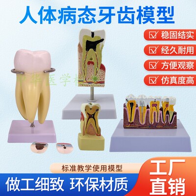 中华模型医患沟通蛀牙教学