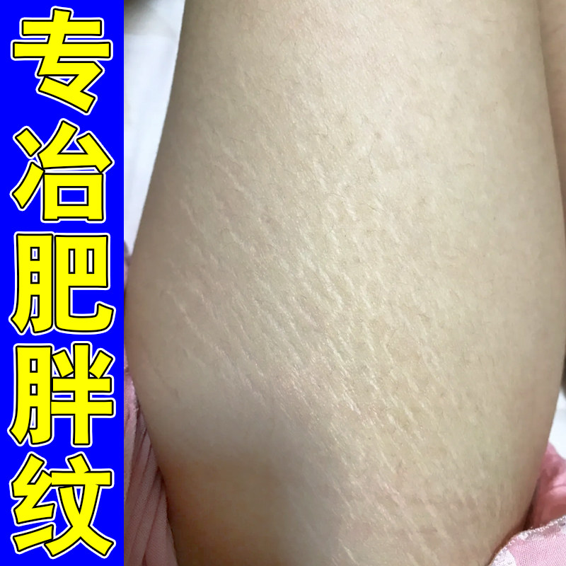 肥胖纹修复霜消除学生大腿生长纹淡化疤痕纹路青少年专用去纹神器