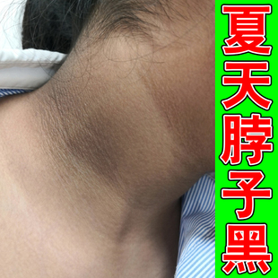 儿童脖子黑外用膝盖关节腋下黑黑的洗不干净脖颈手肘黑色素沉淀