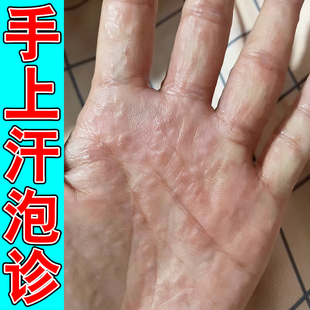 手上汗状泡痒手掌心刺挠痒长小水泡手过敏干痒外用膏