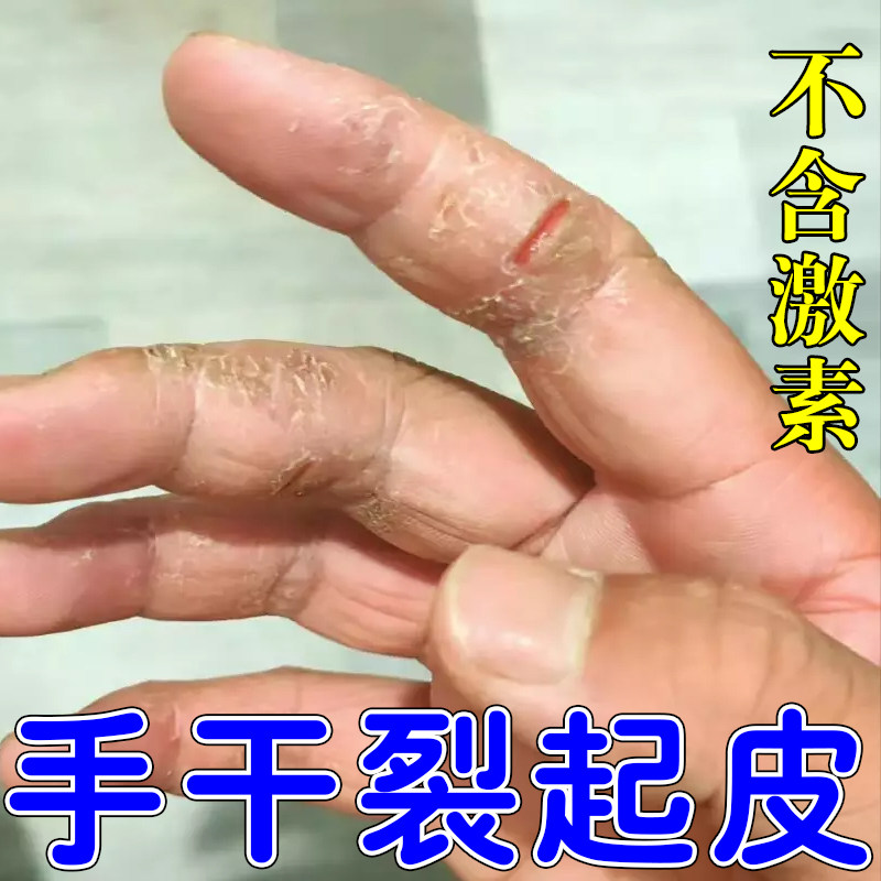 手指脱皮干裂严重手指头脱皮蜕皮痒真菌感染干燥粗糙起皮屑药软膏