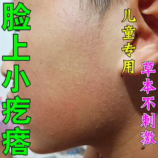 毛囊红斑黑变病药小孩脸上有小颗粒起小疙瘩儿童逆光疹修复专用膏