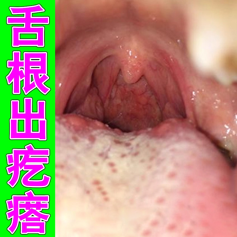 舌根出疙瘩长小红点滤泡增生肿胀疼痛舌头两侧凸起