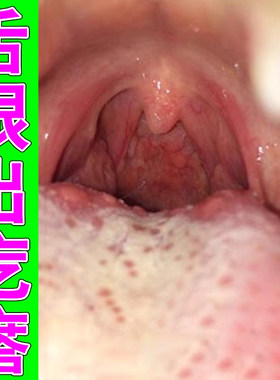舌根出疙瘩长小红点滤泡增生肿胀疼痛舌头两侧凸起