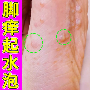 脚底起水泡干燥脱皮脚痒脚上长汗状小水泡小红点起皮屑痒