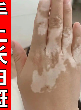 手背长白斑促进黑色素生长补骨脂酊手上肤色不均有白色斑点块