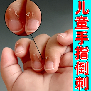 手指起倒刺修复受损儿童成人手上干裂皮去死皮肉刺疼起皮护手霜
