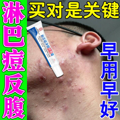淋巴痘腮边痘脸上痘痘凹洞修复去青春痘粉刺闭口痤疮祛痘印神器