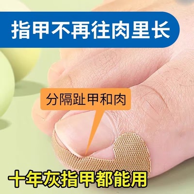 甲沟神器指甲矫正器隔离脚趾甲长肉里填充垫片纠正甲炎嵌甲专用贴